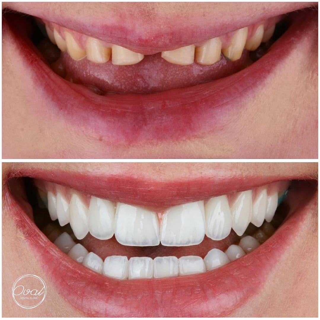 Smile Makeover Case 16 | Oval Dental Clinic