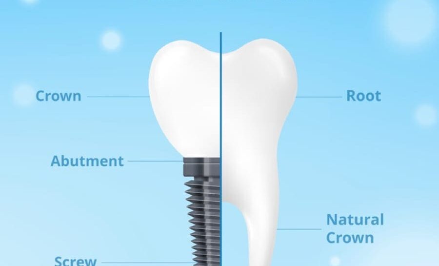 Dental-Implant900-700