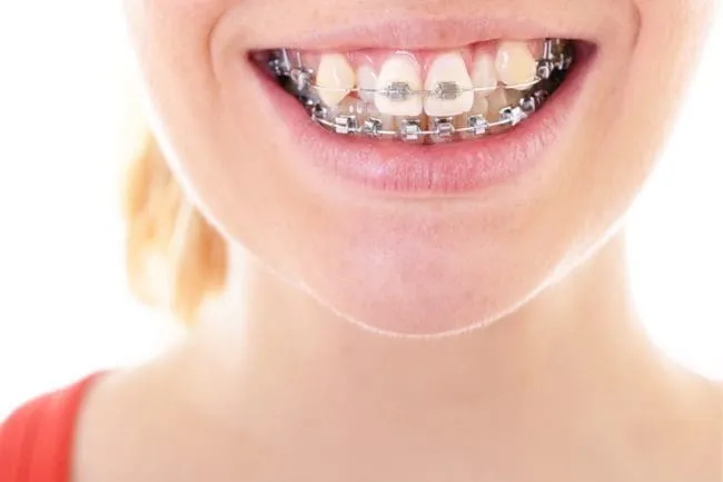 Orthodontic treatment