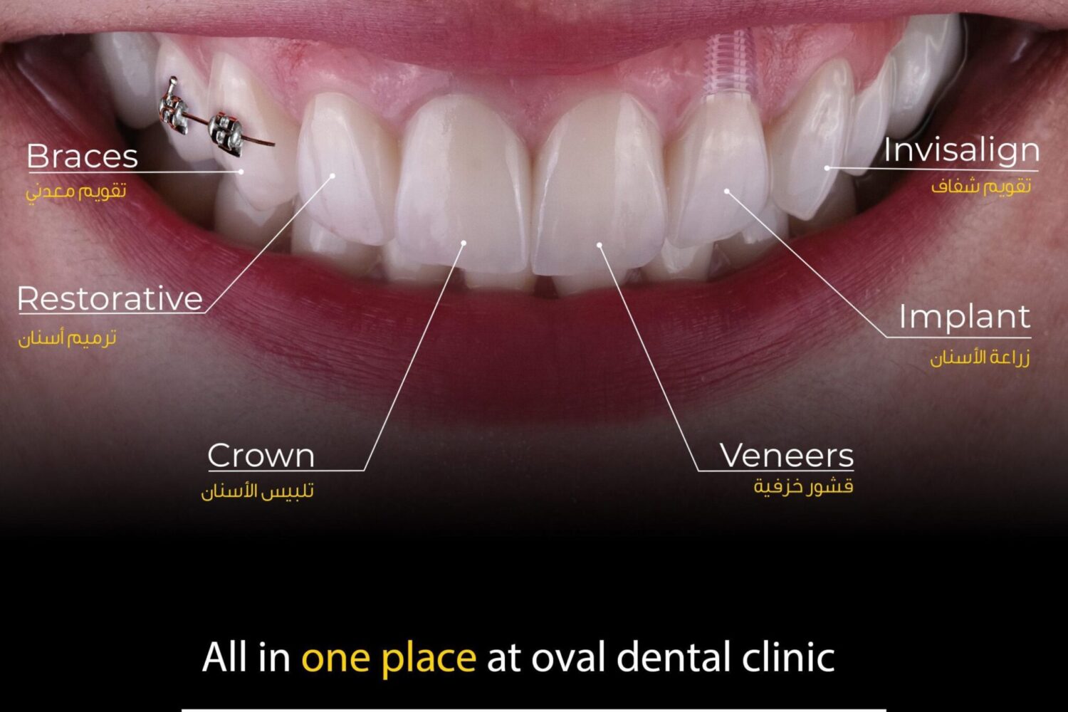 Apicoectomy - Oval Dental Clinic