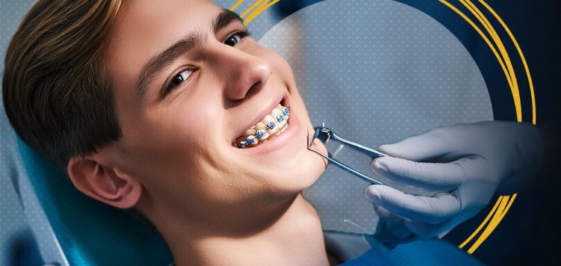 braces extraction