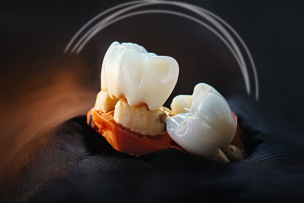 do all impacted wisdom teeth need to be removed