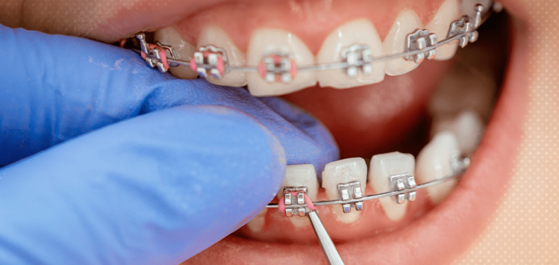 braces treatment cost