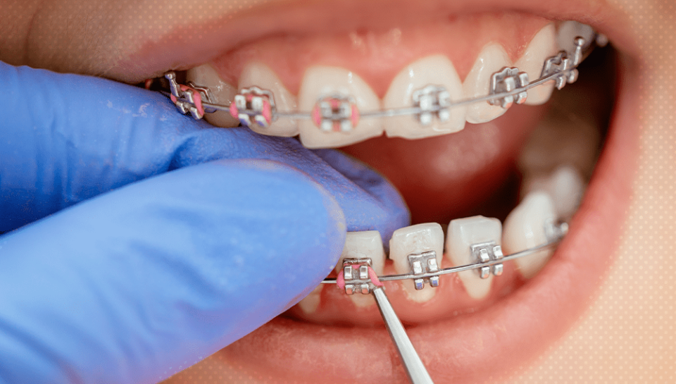 braces treatment cost