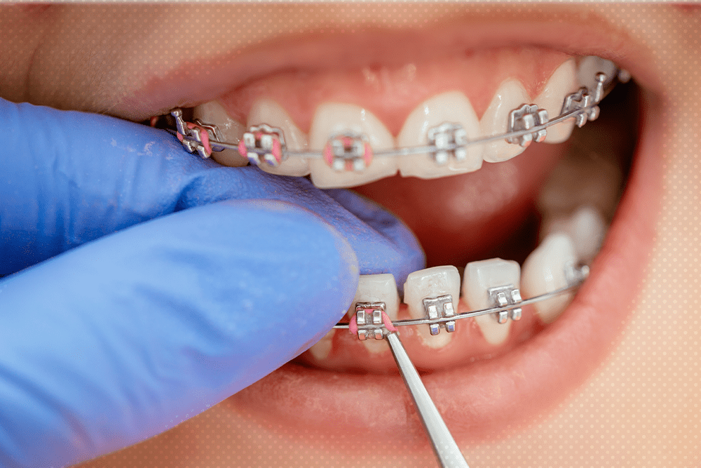 braces treatment cost