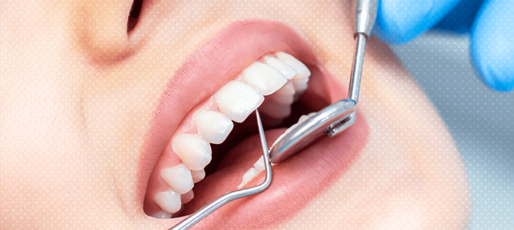 veneers cost in dubai