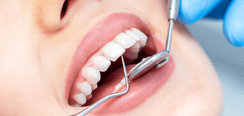 veneers cost in dubai