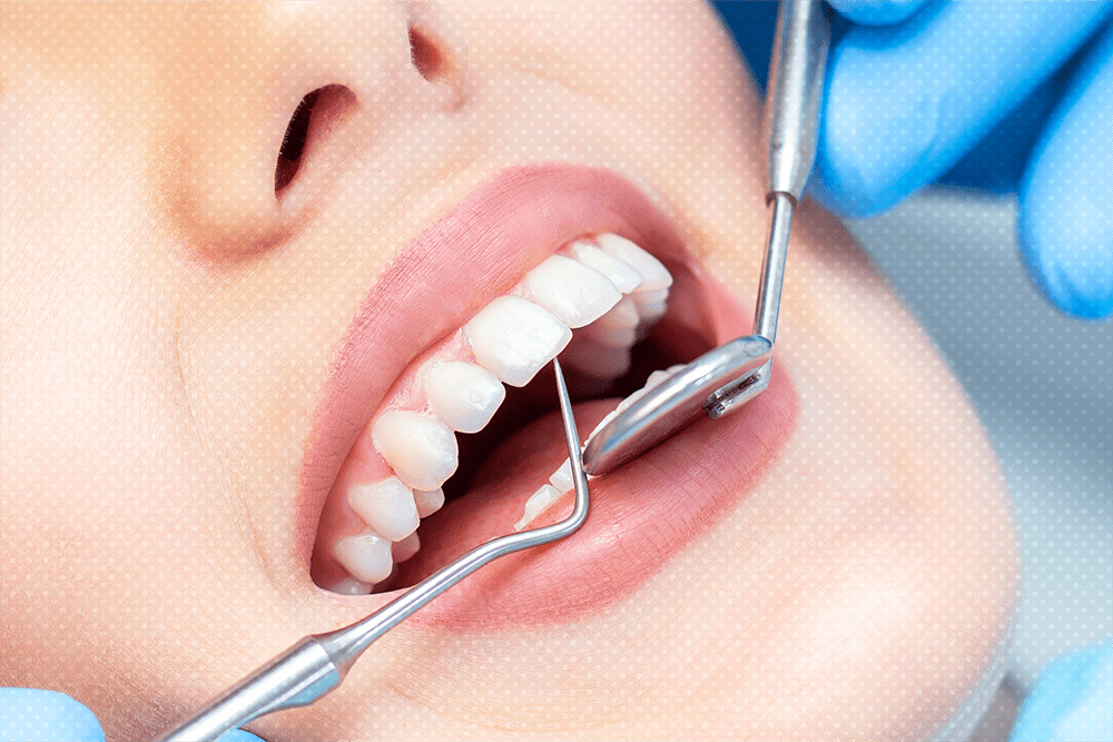 veneers cost in dubai