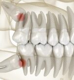 impacted wisdom teeth