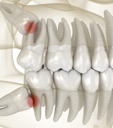 impacted wisdom teeth