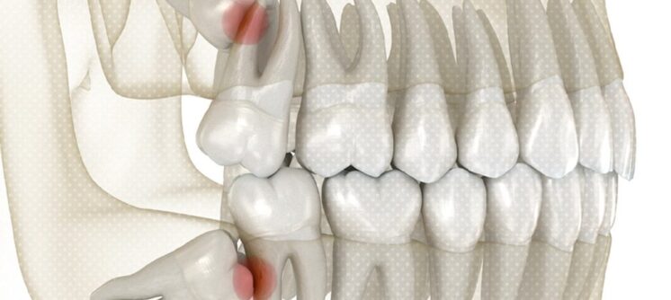 impacted wisdom teeth