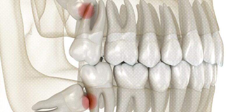 impacted wisdom teeth