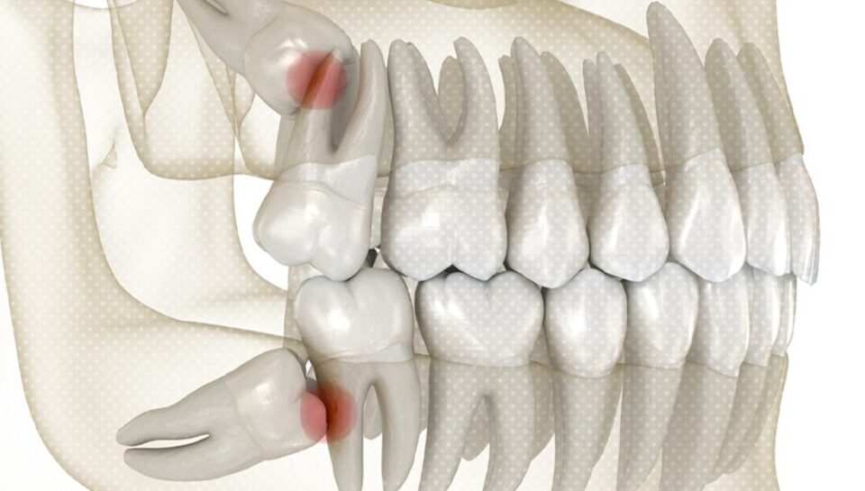 impacted wisdom teeth