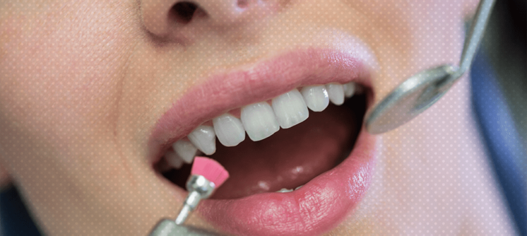 teeth scaling and polishing