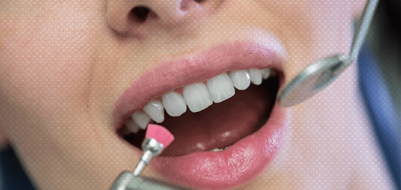 teeth scaling and polishing