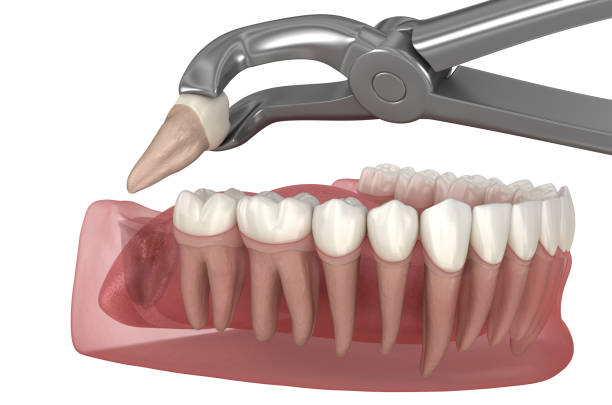 Extraction of wisdom tooth. Medically accurate tooth 3D illustration.