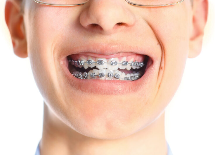 Close-up mouth of tooth with braces over white background.