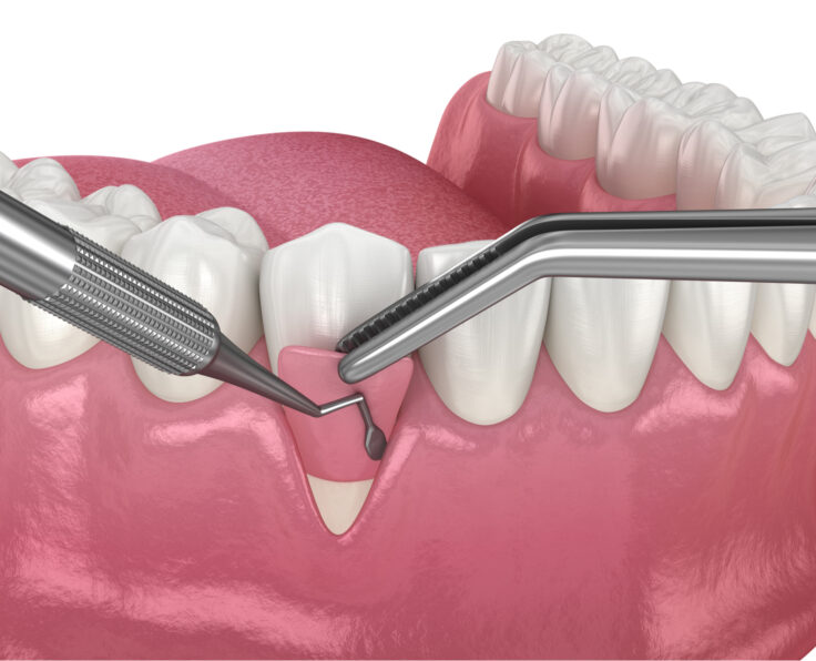 Gum Tissue Grafting