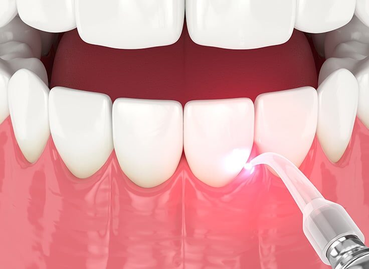 Laser-Peridontal-Gum-Treatment-1