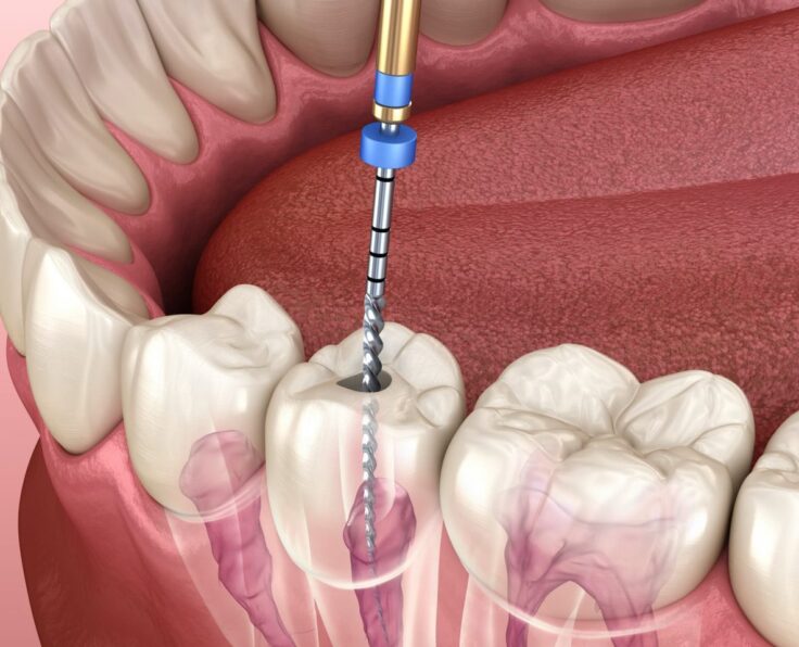 Root-Canal-Treatment