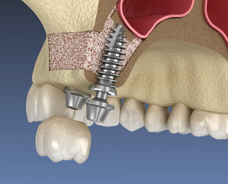 Sinus Lift