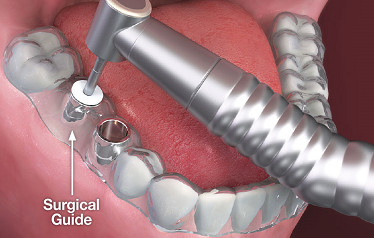 Surgical Guided Dental Implants