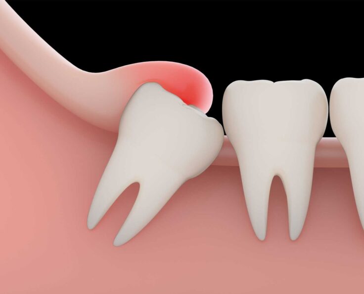 Wisdom-Teeth-Extraction