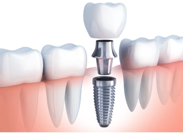 houston-dental-implants