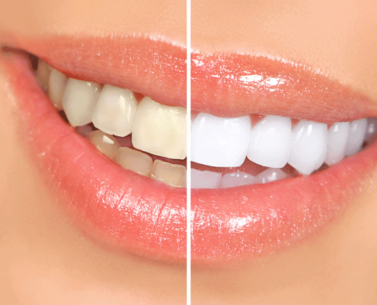 how-does-professional-teeth-whitening-work