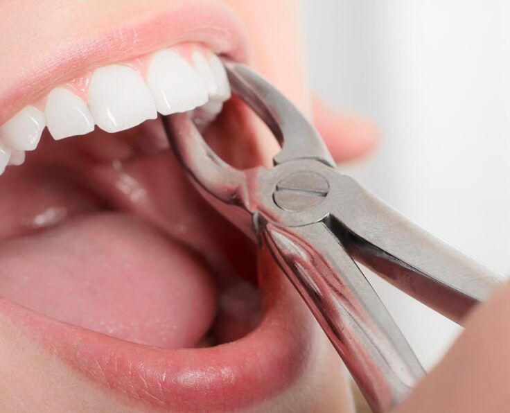 tooth-extraction-blog-1