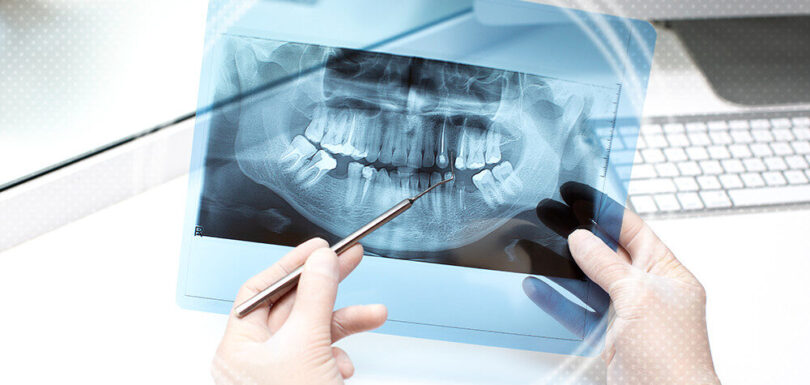 signs of dental bone graft failure