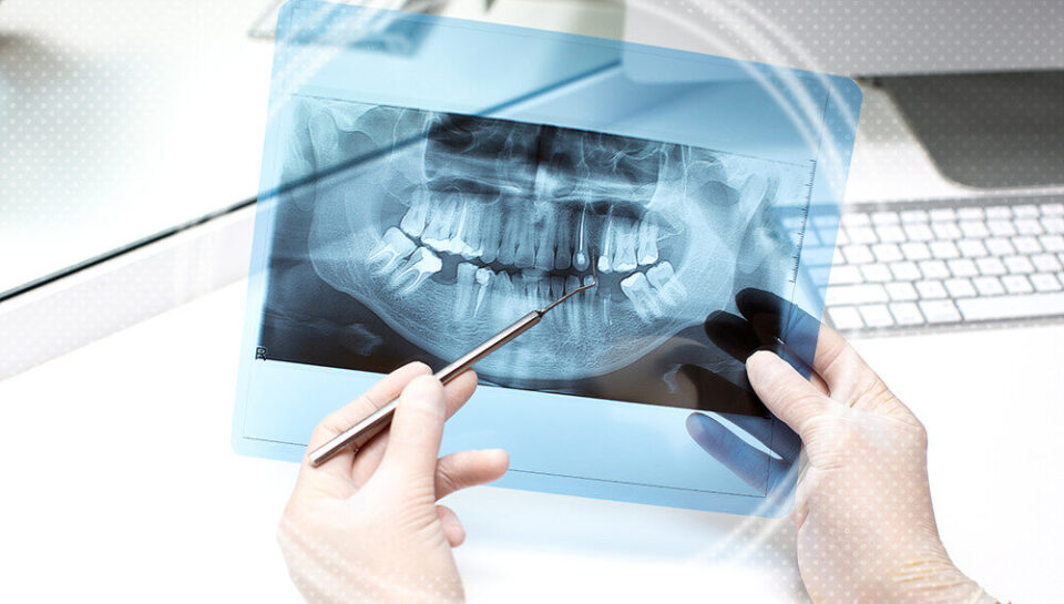 signs of dental bone graft failure