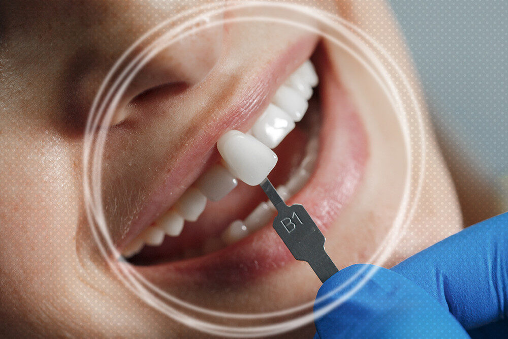 Top 5 Cosmetic Dentistry Options for Crowded Teeth