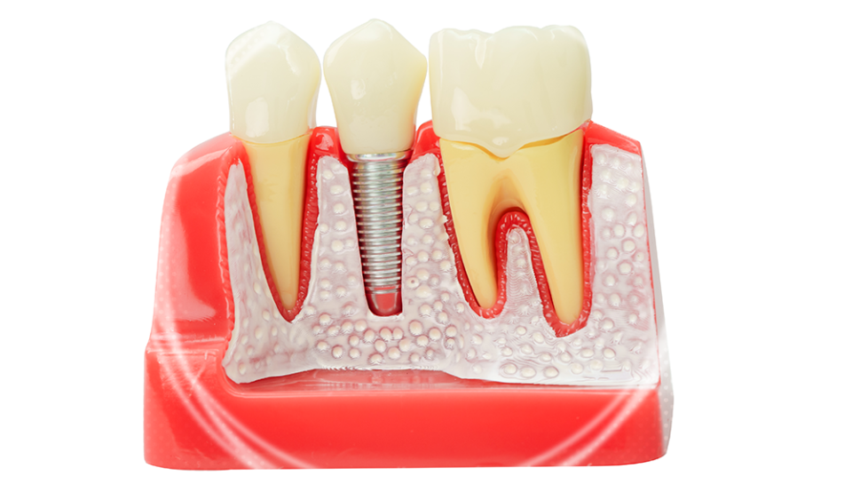 Dental Bone Graft Recovery