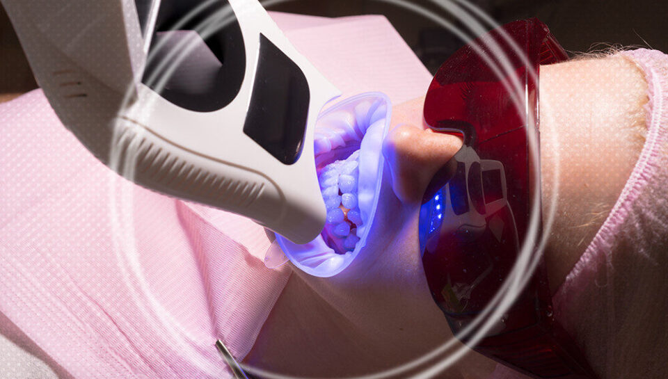 Most Common Laser teeth cleaning side effects