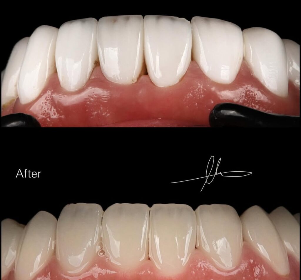 Before and After smile makeover by the best cosmetic dentist Dubai using world-class veneers