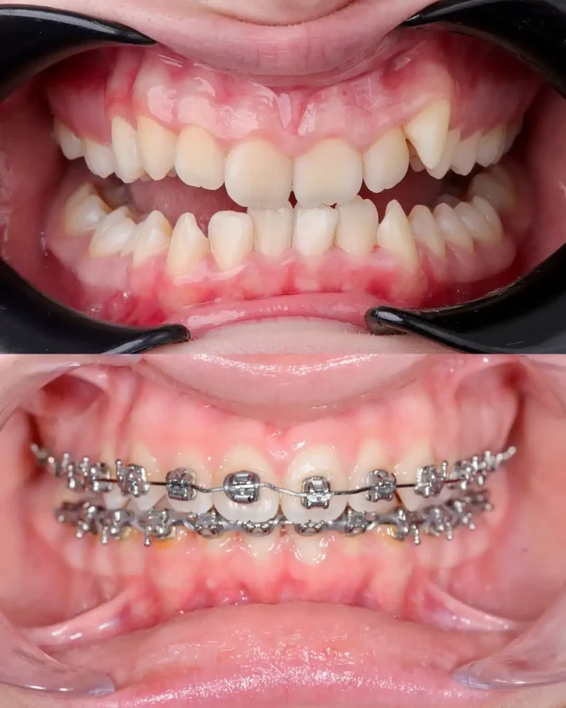 tooth braces before and after results dubai