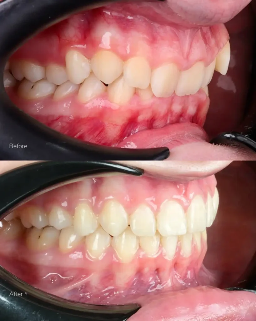 tooth braces before and after results dubai