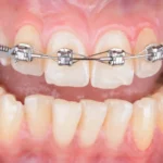 metal tooth braces treatment dubai clinic