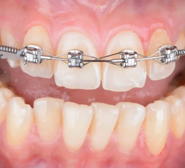 metal tooth braces treatment dubai clinic