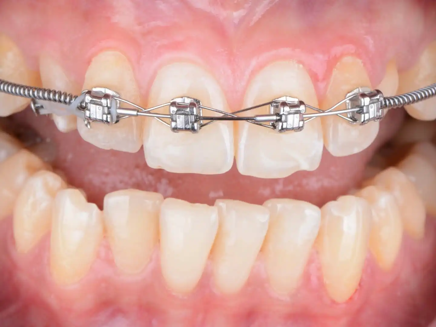 metal tooth braces treatment dubai clinic