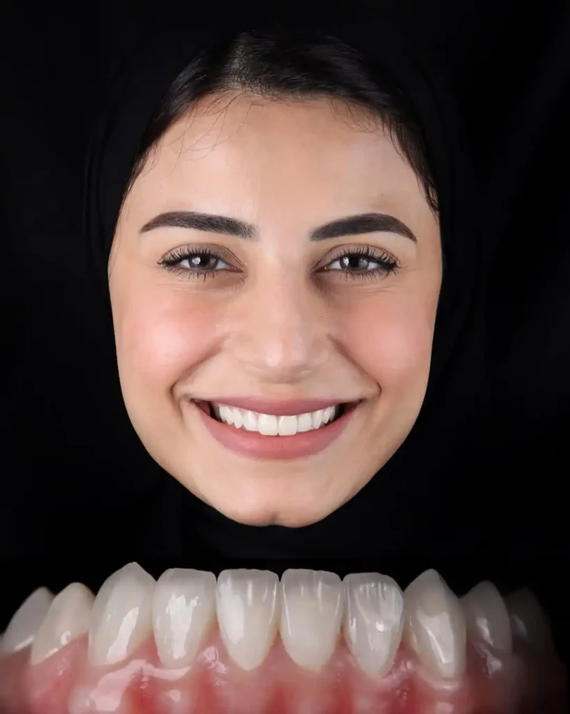 tooth braces treatment result in dubai clinic
