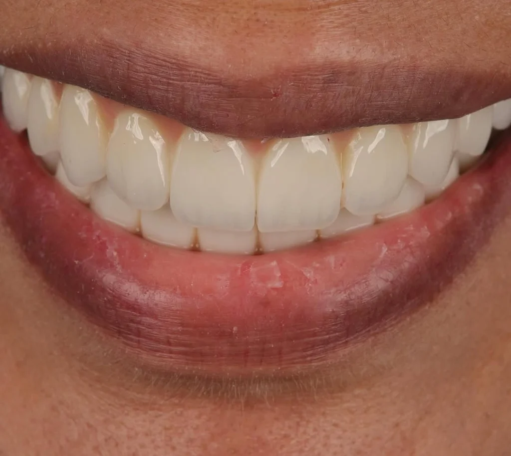 A close-up look at one of the top 10 best veneers in the world