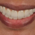 A close-up look at one of the top 10 best veneers in the world