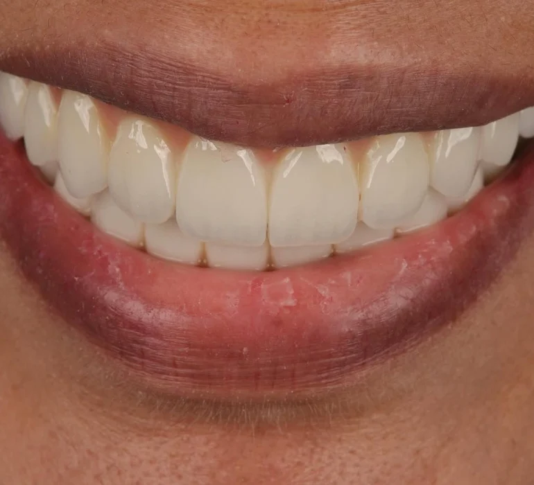 A close-up look at one of the top 10 best veneers in the world