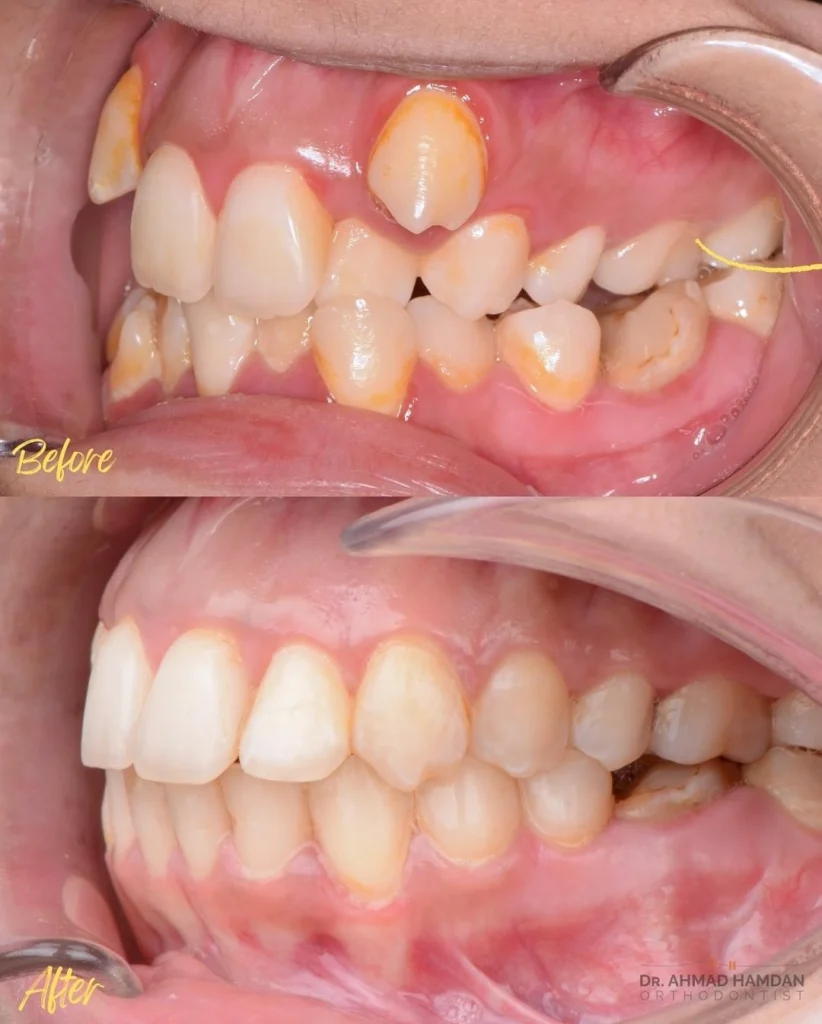 Smile transformation after braces treatment