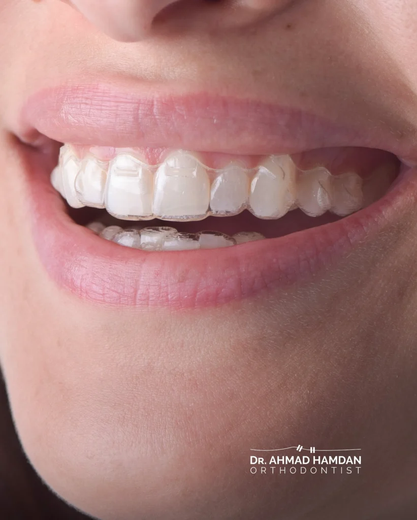 Metal ceramic and clear braces comparison
