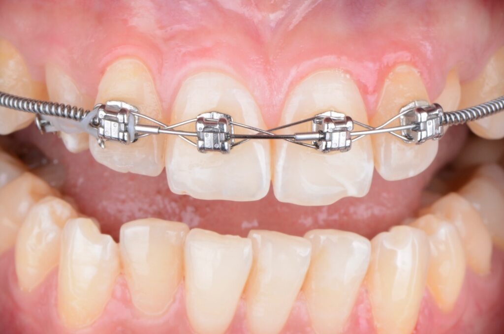 Brackets for teeth price consultation at Oval Dental Clinic Dubai