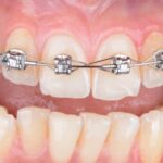 Brackets for teeth price consultation at Oval Dental Clinic Dubai