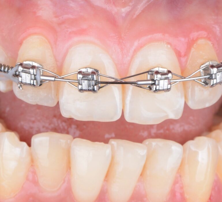 Brackets for teeth price consultation at Oval Dental Clinic Dubai